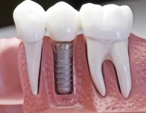 implantaciya-zubov-roskosh-ili-neobhodimost