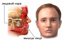 Лицевой паралич