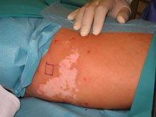 Разработка лечения шрамов ReCell - одно из самых перспективных направлений медицины