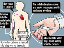 Небольшой разрез на запястье спас жизнь мужчине после сердечного приступа