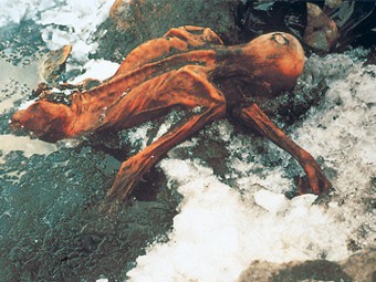 У альпийской мумии Отци выявили современные болезни пародонта