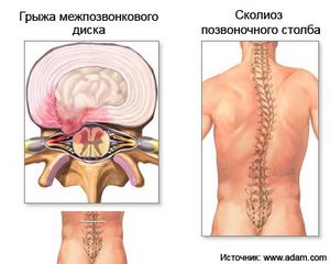 Диагностика и лечение острых поясничных болей 