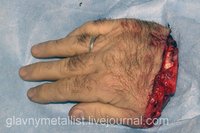 В Краснодарском крае хирурги пришили мужчине отрезанную кисть 