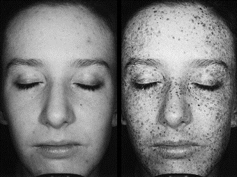 Ультрафиолетовые фотографии помогли оценить риск рака кожи у детей