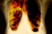 Мезотелиома: диагноз с помощью анализа дыхания
