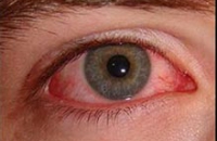 Заражение гриппом может вылиться в болезни глаз