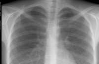 Рентген-cканирование в аэропортах вредит здоровью