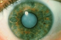 Статины повышают риск развития катаракты