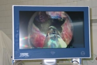 Сексуальная функция после фотоселективной вапоризации простаты Сексуальная функция после фотоселективной вапоризации простаты
