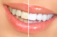 Как можно отбелить зубы?