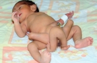 6 ног – не приговор: врачи борются за жизнь необычного младенца