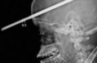 Американские хирурги успешно извлекли 90-сантиметровый гарпун из черепа подростка