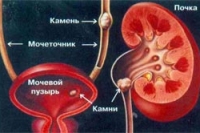 Мочекаменная болезнь: опасна, но излечима Мочекаменная болезнь: опасна, но излечима