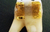 Технологичная «татуировка на зубе» ставит диагноз по дыханию