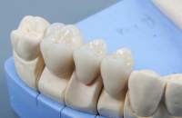 Основные стадии протезирования зубов