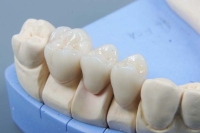 Основные стадии протезирования зубов