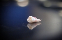 В тульской поликлинике уборщица удалила ребенку здоровый зуб