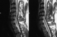 Боль при травмах спинного мозга на срок до 8 месяцев может убрать одна инъекция!