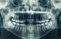 Рентген зубов: виды снимков, показания
