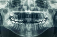 Рентген зубов: виды снимков, показания