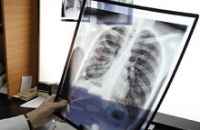 Ученые со всего мира трудятся над созданием лекарства от туберкулеза для бедных государств