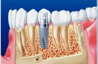 Cовременное протезирование зубов