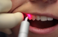Лазерная стоматология — стоматология без боли