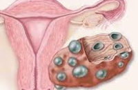 Дамы с синдромом поликистозных яичников подвергаются высокому риску развития тромбозов