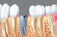Мифы об имплантации зубов