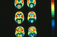 Необычное расстройство: в мозге мужчины звук опережает картинку