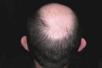 Пересадка волос может навредить, заявляют эксперты