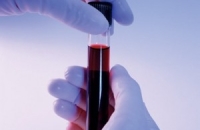 Новой анализ крови спасет от тромбоза