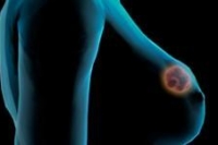 Sanofi фокусирует свои усилия на решении трудности рака молочной железы в Украине Sanofi фокусирует свои усилия на решении трудности рака молочной железы в Украине