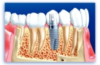 О типах протезирования зубов