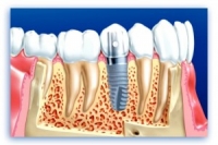 О типах протезирования зубов