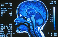 Обнаружены новые симптомы снижения умственных способностей