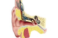 Сотворен имплантат для глухих людей, с которым можно плавать и спать