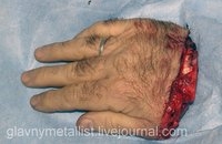 В Краснодарском крае хирурги пришили мужчине отрезанную кисть
