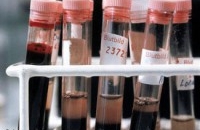 Новый анализ крови поможет в лечении рака простаты