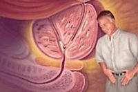 Аденома предстательной железы: признаки и лечение