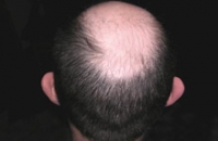 Мужчины, потерявшие волосы в среднем возрасте, рискуют пострадать от рака