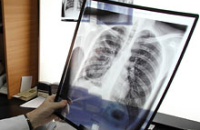 Вместо традиционной БЦЖ предлагают новую вакцину против туберкулеза