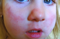 Фаст-фуд делает из детей аллергиков