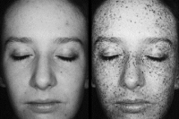 Ультрафиолетовые фотографии помогли оценить риск рака кожи у детей Ультрафиолетовые фотографии помогли оценить риск рака кожи у детей