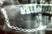 Имплантат «велосипедная цепь» позволил восстановить челюсть