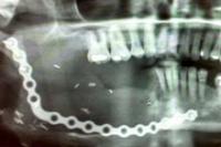 Имплантат «велосипедная цепь» позволил восстановить челюсть