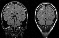 Магнитно-резонансная томография головы и головного мозга