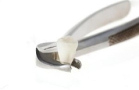Удаление зубов — не решение всех проблем