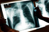 Ученые предложили определять туберкулез по дыханию бактерий