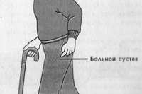 Какой искусственный тазобедренный сустав лучше? Какой искусственный тазобедренный сустав лучше?